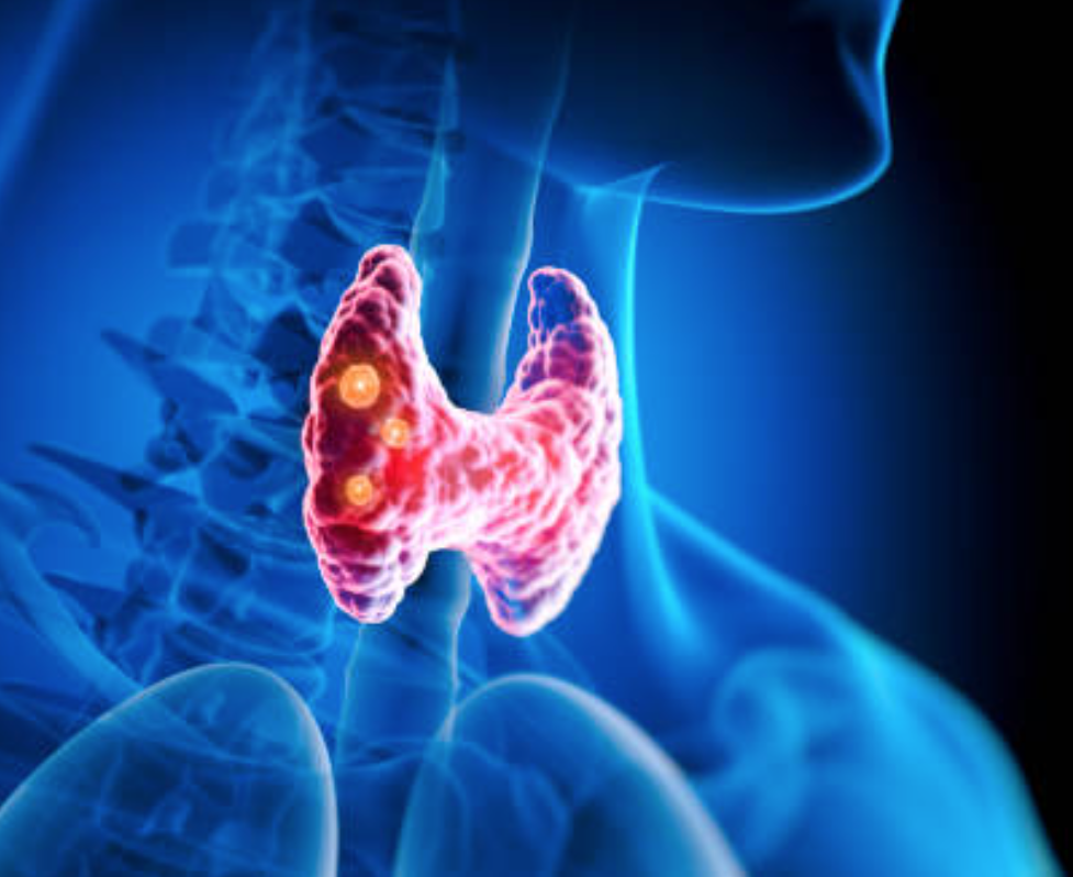 hyperthyroidie basedow solutions naturelles